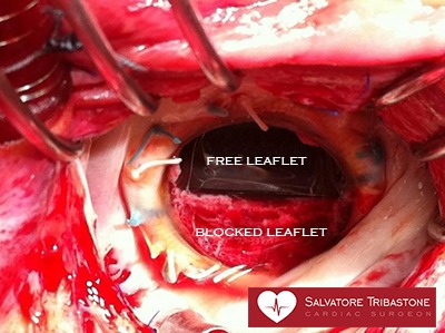 Prosthetic valve thrombosis