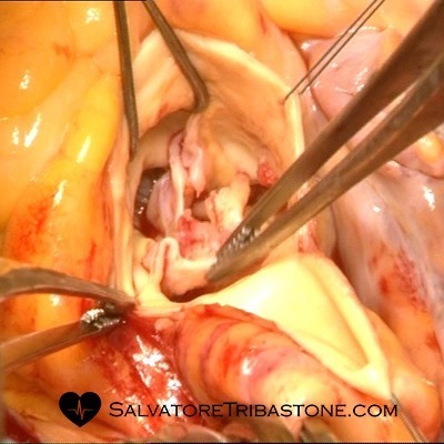 Endocarditis on Aortic Valve