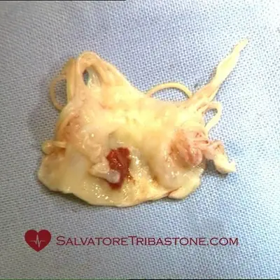 Excised endocarditic mitral valve