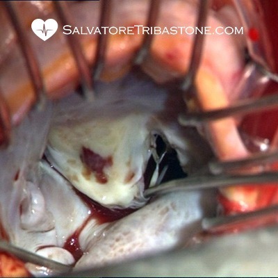 Endocarditis on Mitral Valve