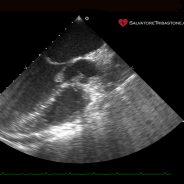 Endocardite Infettiva