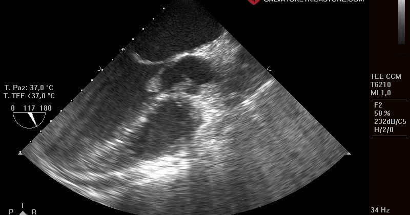 Endocardite Infettiva