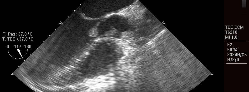 Infective Endocarditis