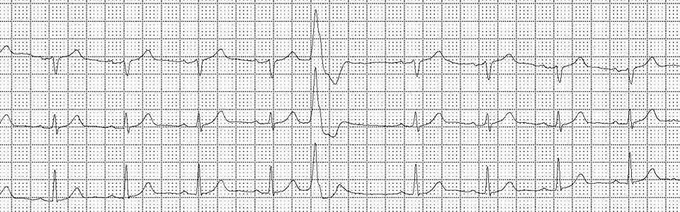 Esame Holter ECG